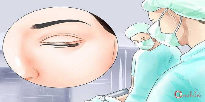 چگونه پف زیر چشم را درمان کنیم