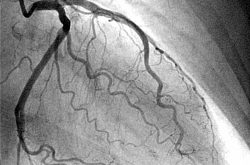 آنژیوگرافی قلب چیست و چرا انجام می‌شود؟