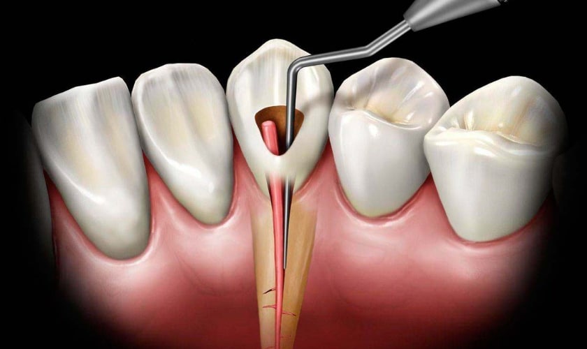 علت و راه حل پیشگیری از پوسیدگی دندان 