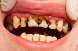 راهکارهای جلوگیری از پوسیدگی دندان