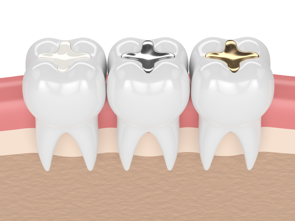 راهنمای کامل پوسیدگی دندان 