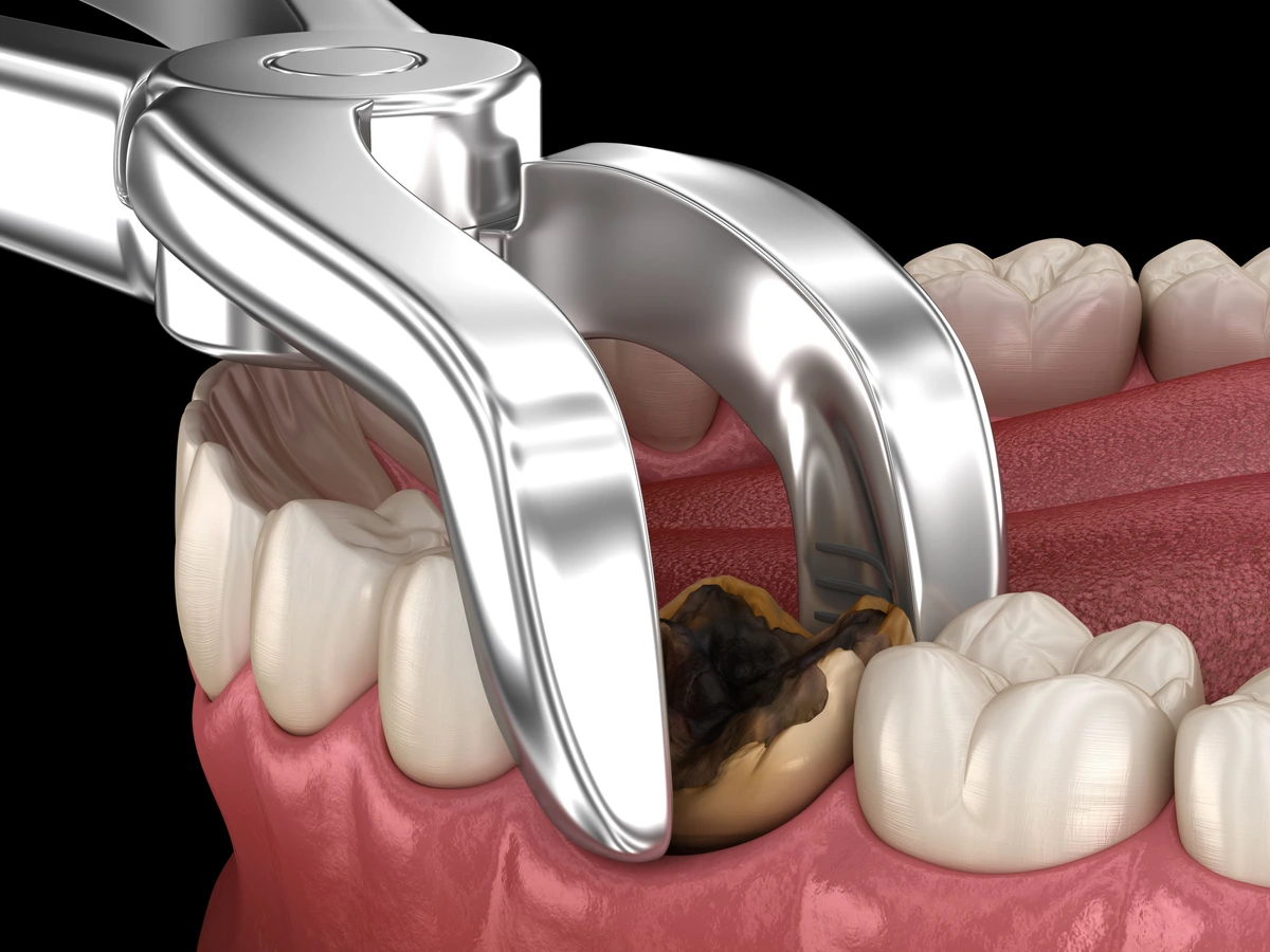 پوسیدگی دندان، از تشخیص تا بهترین روش های درمان 